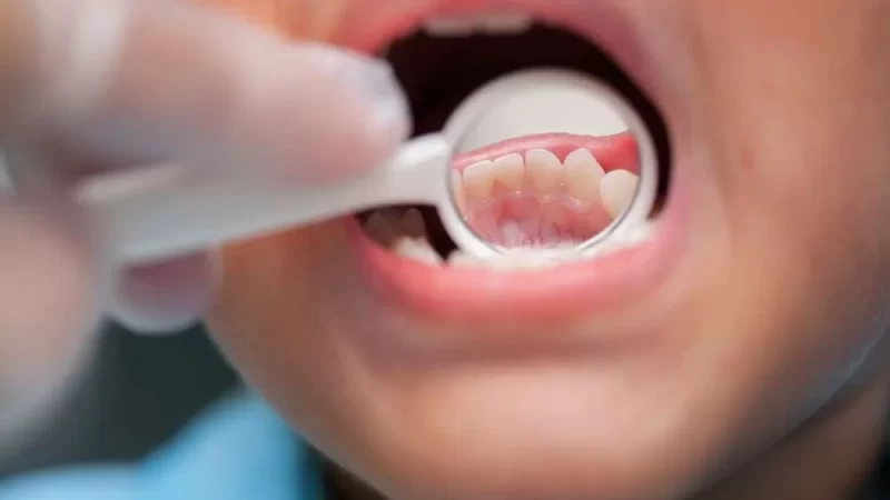 Protecting Young Smiles: Insights into Juvenile Periodontitis
