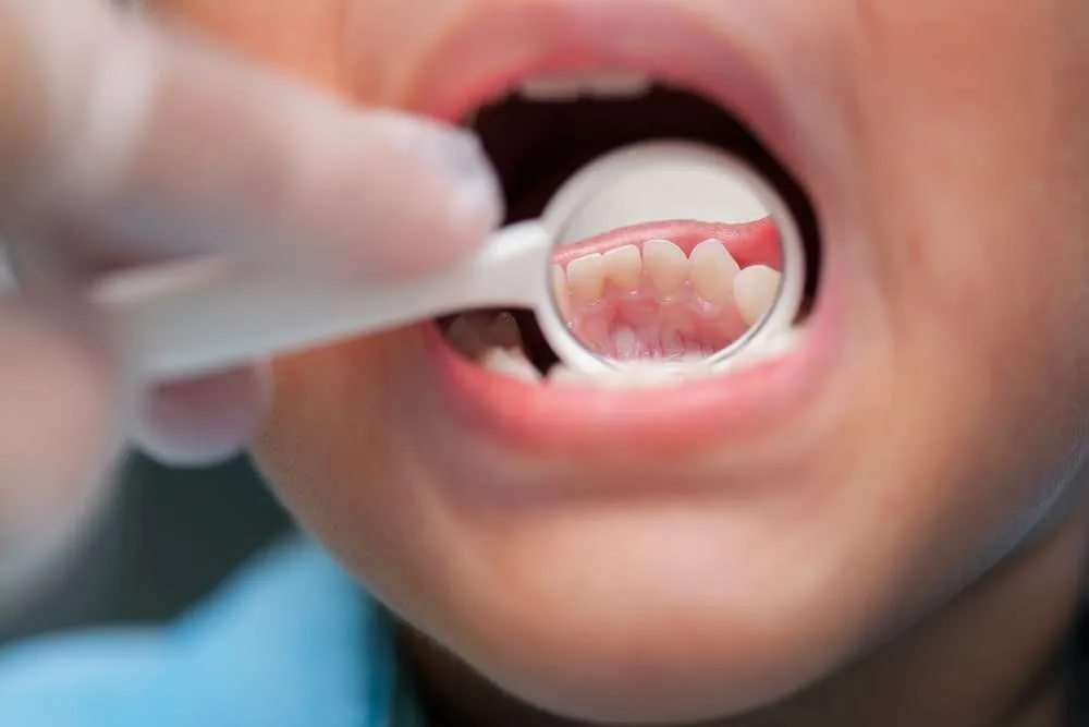 Protecting Young Smiles: Insights into Juvenile Periodontitis