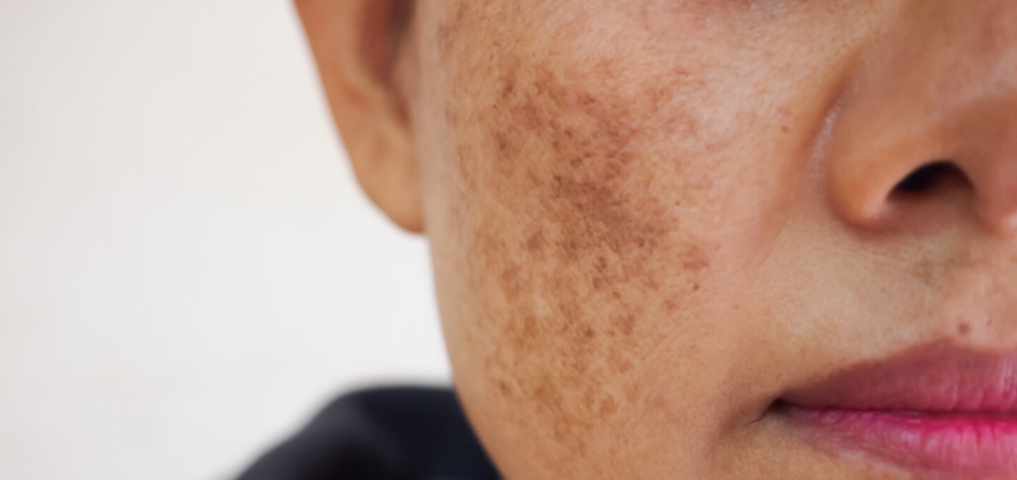 Banish Melasma with Innovative Melasma Treatment Options