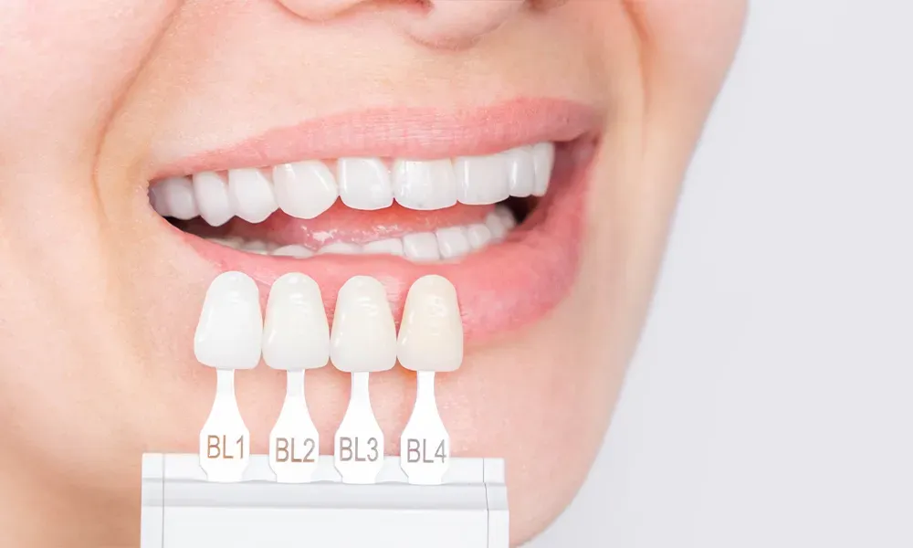 Porcelain Veneers– When It Is Preferred?