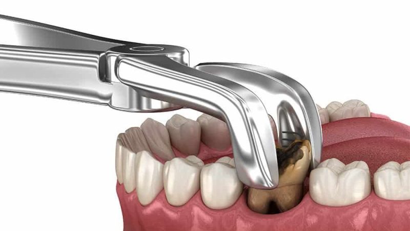 Molar Treatment