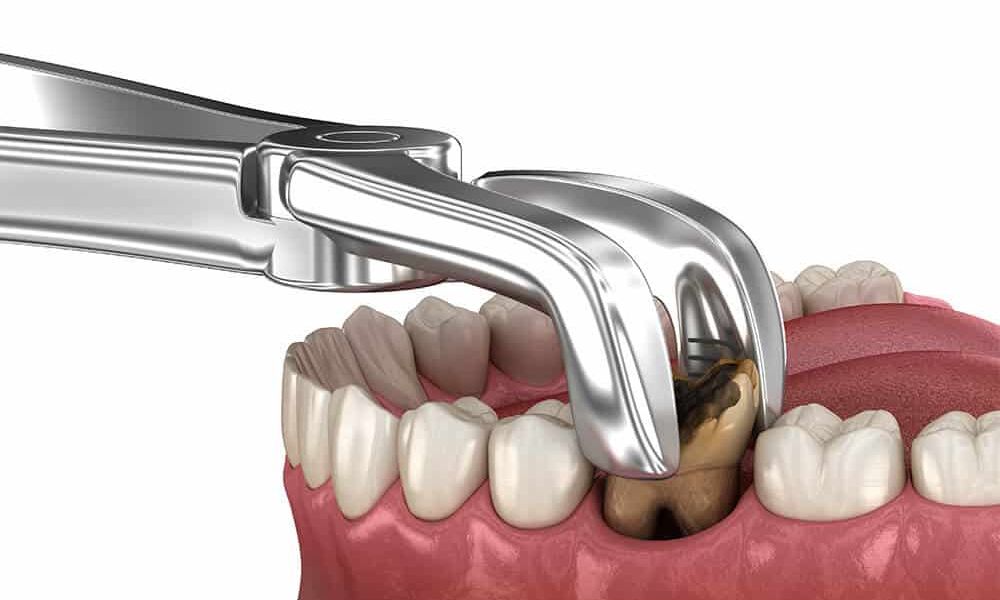 What to Expect During Cracked Molar Treatment